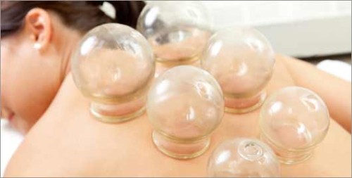 Acupuncture-Cupping-Treatment